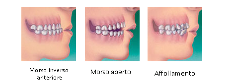 trattamento ortodontico Padova Treviso