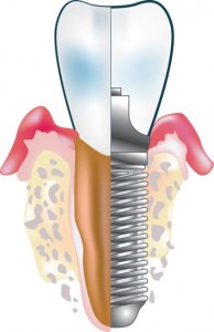 cos-e-implantologia estetica