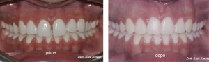 trattamento ortodontico prima